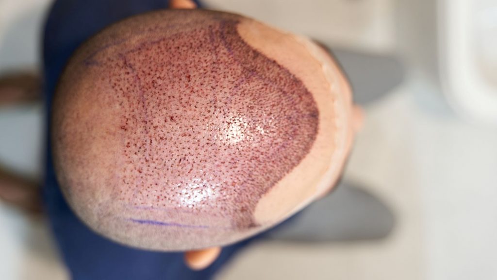 Top Things to Know Before You Start Your Scalp Micropigmentation